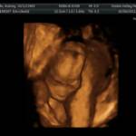 20 weeks - hiding from mommy and daddy!