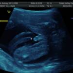 20 weeks - it's a boy!