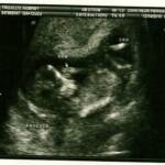 12 weeks, 2 days

We heard the heartbeat that day! 164 bpm!!!
Baby looks like Matthew, I think... but it could just be the bald head that's making me think that!  It was moving around a lot and I swear it waved at us :)