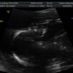 20 weeks - Profile again