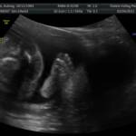 20 weeks - Right foot!